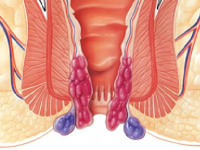 Hemoroidin belirtileri